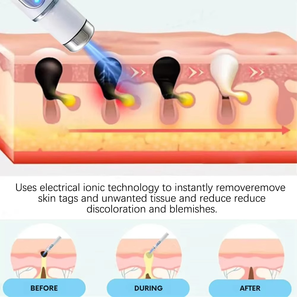 Non-Invasive Remover Pen – Professional Device for Face & Body, Gentle for All Skin Types Remover Tool Kit, Blemish Extractor Set